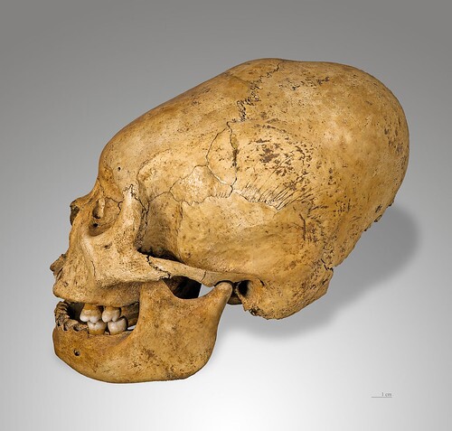 cranialdeformation