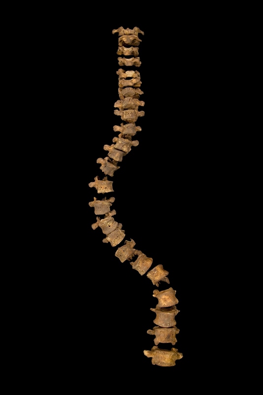 spinalcurvature2