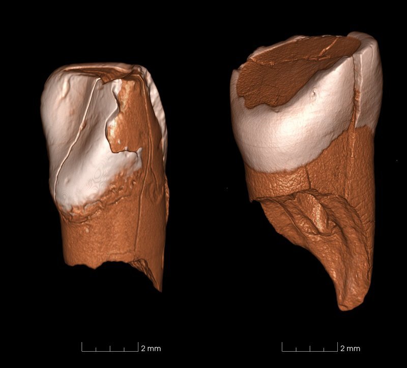 dentaltomography3