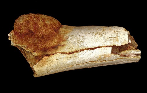 footbonecancerfig