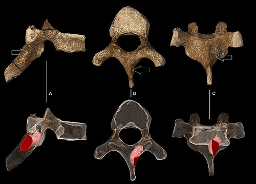 vertebracancerfig