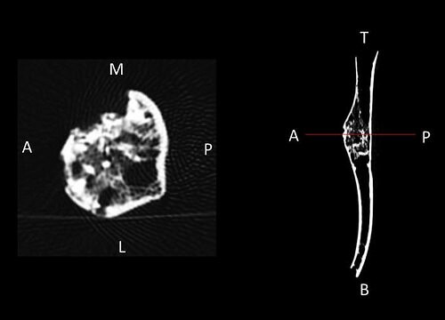 bonecancer3