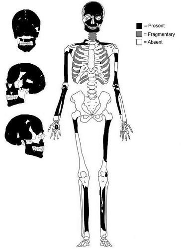 bonecancer2